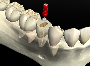 虫歯とは イメージ画像