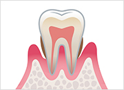歯周炎（中等度） イメージ画像